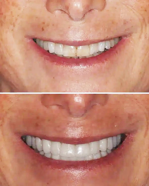 Before and after comparison of smile transformation showing improved tooth whiteness and alignment.