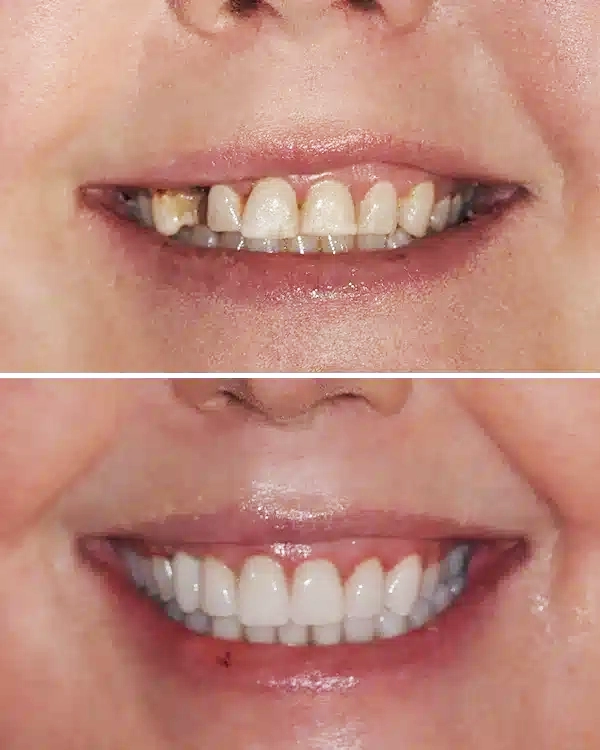 Before and after comparison of teeth whitening results showing improved tooth brightness and smile enhancement.