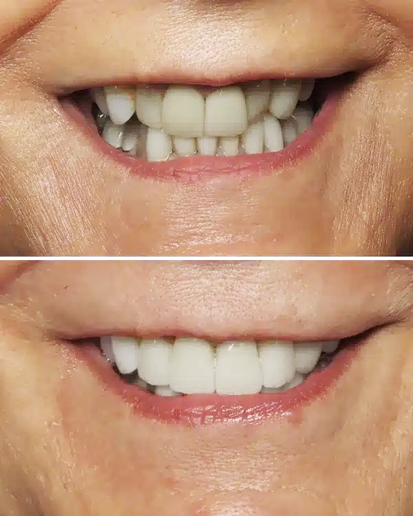 Before and after dental smile transformation showing improved teeth alignment and whitening results.