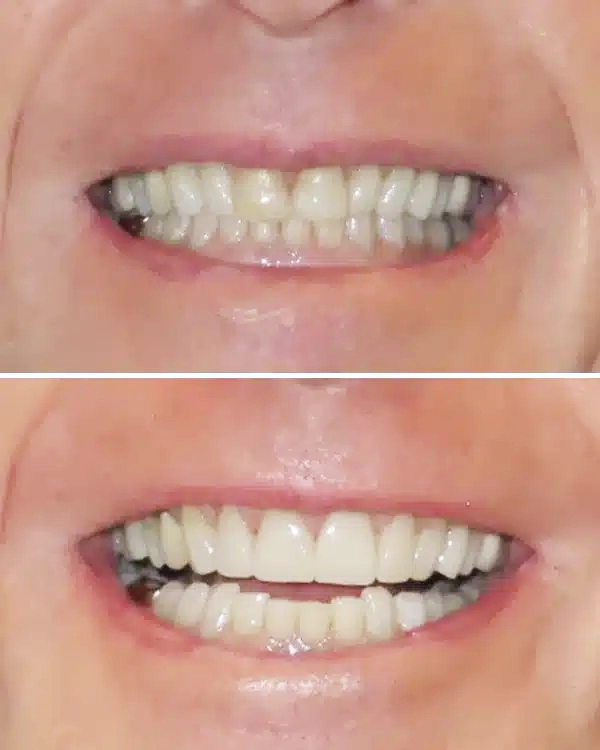 Before and after dental treatment showing improved teeth alignment and whiteness from PV Smiles cosmetic dentistry.