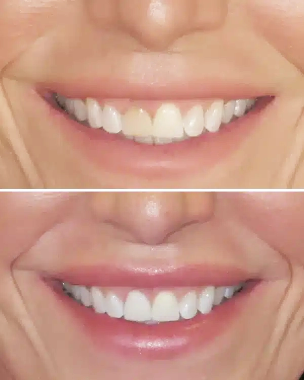Before and after comparison of smile transformation showing whitened, aligned teeth and enhanced gum display.