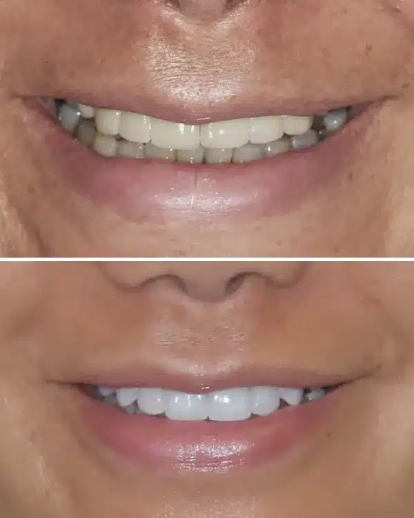 Before and after dental treatment comparison showing improved tooth whiteness and alignment at PV Smiles.