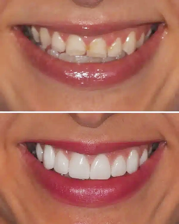 Before and after comparison of teeth whitening results showing improved brightness and whiteness.
