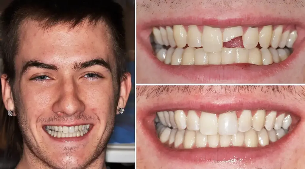 Before and after dental transformation showing man's smile improvement and teeth whitening results.