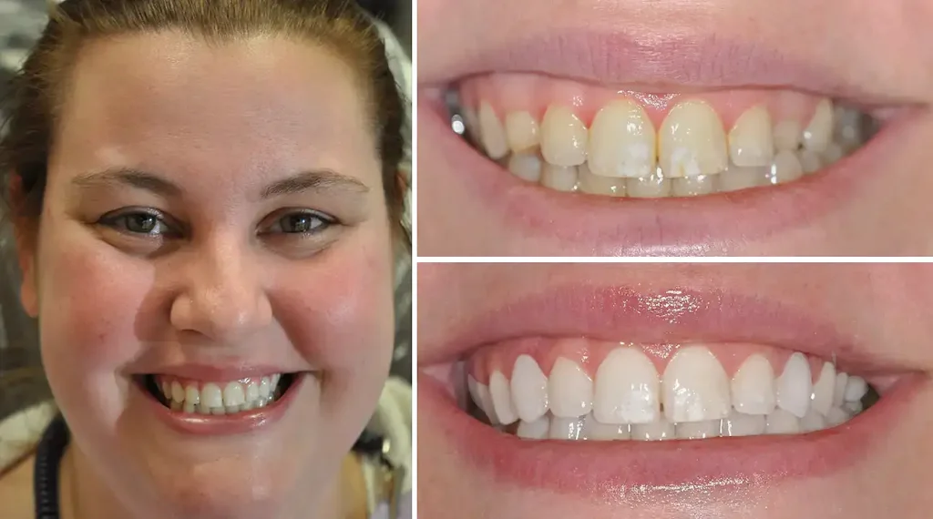 Before and after dental transformation showing smile improvement and teeth whitening results.