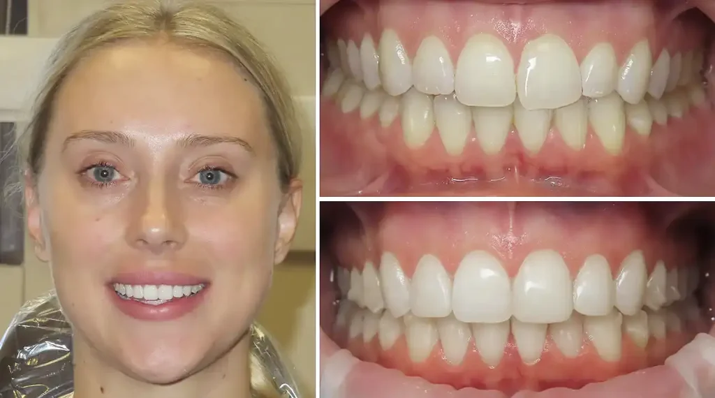 Woman smiling showing teeth before and after dental treatment results at PV Smiles.