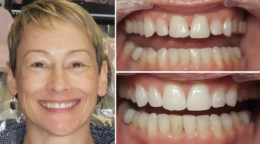 Before and after dental transformation showing woman's smile improvement with whitened, straightened teeth.