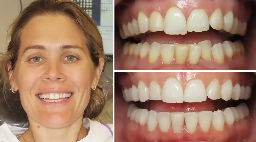 Woman's smile before and after dental treatment showing teeth whitening results