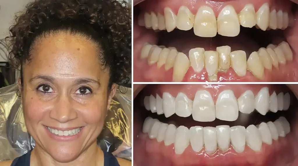 Before and after dental work showing woman's smile transformation with whitened, straightened teeth