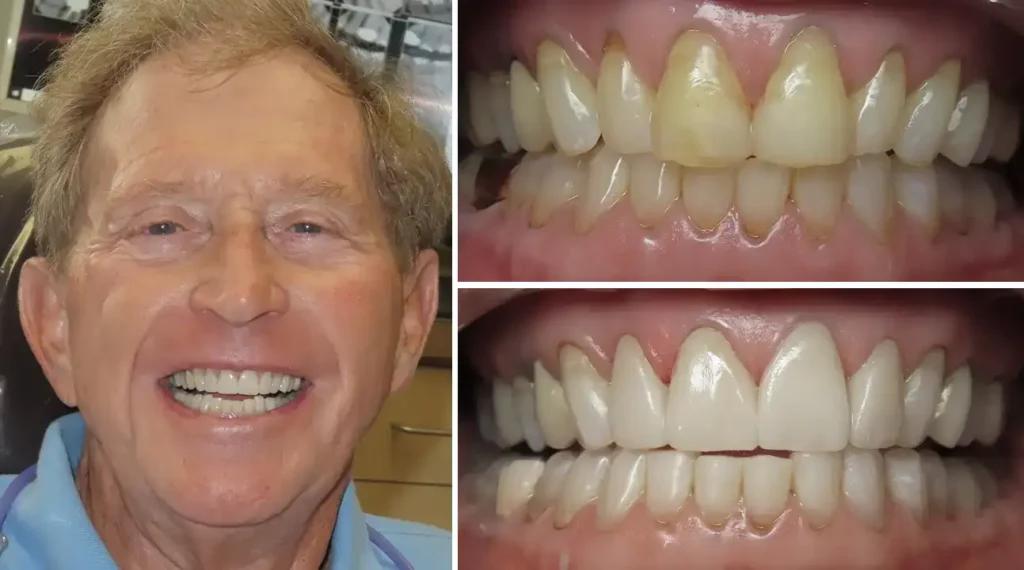 Man smiling showing before and after dental whitening results with improved tooth color and brightness.