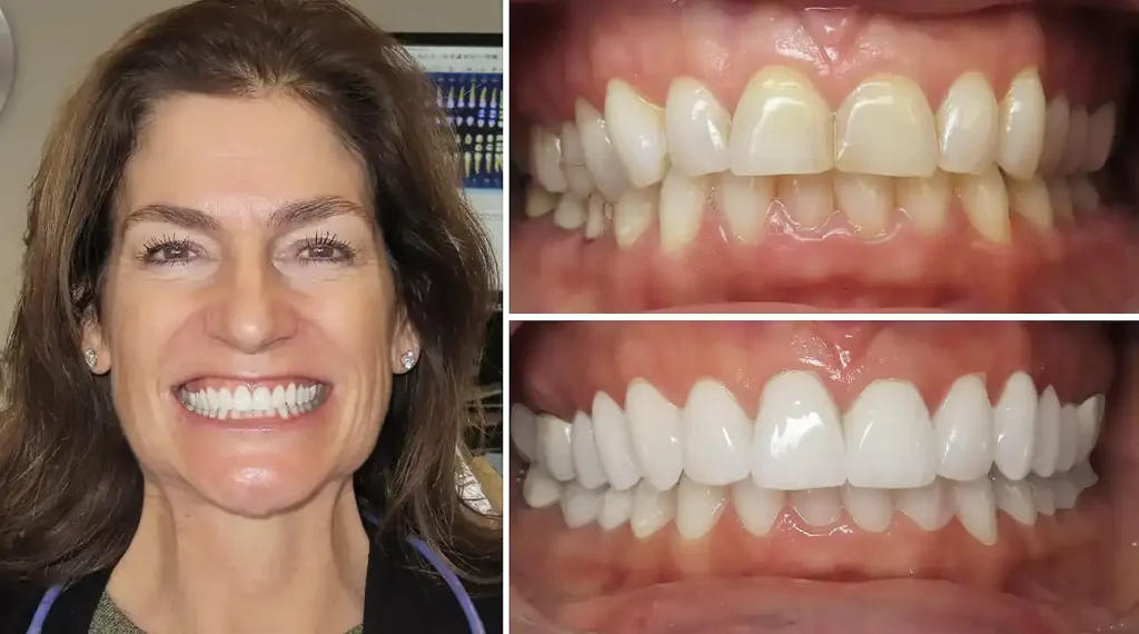 Woman's smile transformation showing before dental work with discolored teeth and after with whitened, aligned teeth.